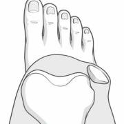 dislocation of the patella