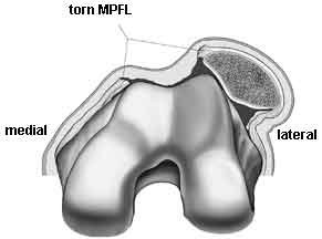 dislocated patella