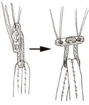 endobutton