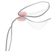 excessive lateral pressure