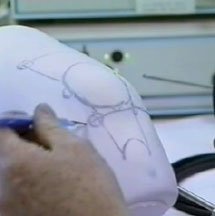 arthroscopy portal