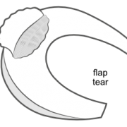 flap tear of the meniscus