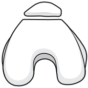 trochlear dysplasia with a flat upper trochlea with no groove