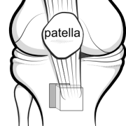 distal realignment osteotomy