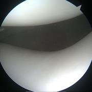 photo taken through the arthroscpe