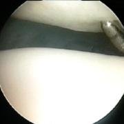 Grade 1 cartilage damage