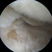 Outerbridge Grade IV - patellar cartilage fibrillated with exposure of underlying bone in the tibia