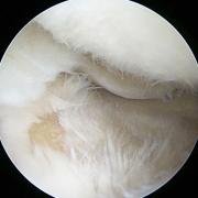 grade 4 cartilage damage