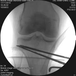 guide-wires.jpg