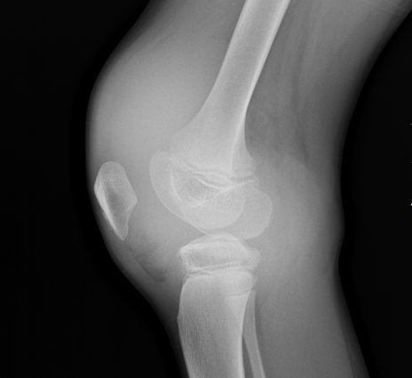 haemarthrosis of the knee