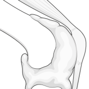 hemarthrosis