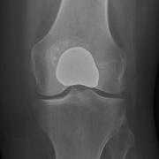 hemicap patellofemoral replacement