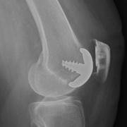 hemicap patellofemoral replacement