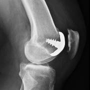 patellofemoral replacement with hemicap