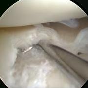 horizontal cleavage tear