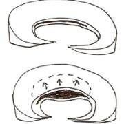 mechanism of a meniscal cyst