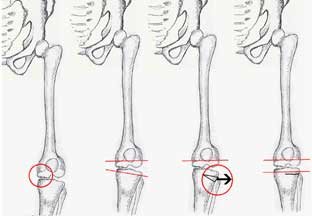 high tibial osteotomy