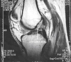 torn acl