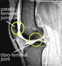 MRI of knee