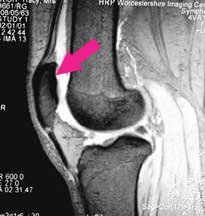 knee mri