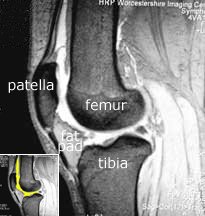 suprapatellar pouch
