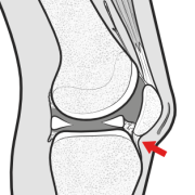 infrapatellar contracture