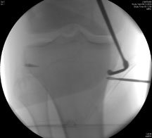 guide wire for chisel