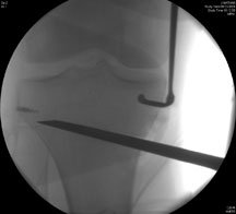 osteotomy chisel