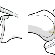 infrapatellar plica and fat pad being stretched with motion