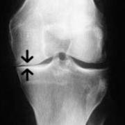 Joint space narrowing in the knee