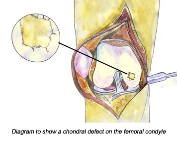 chondral defect on femur