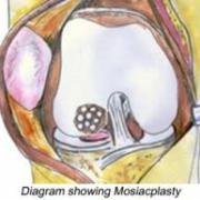 mosaicplasty