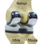 total knee replacement on model