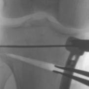 laminar spreaders opening the bone during high tibial osteotomy