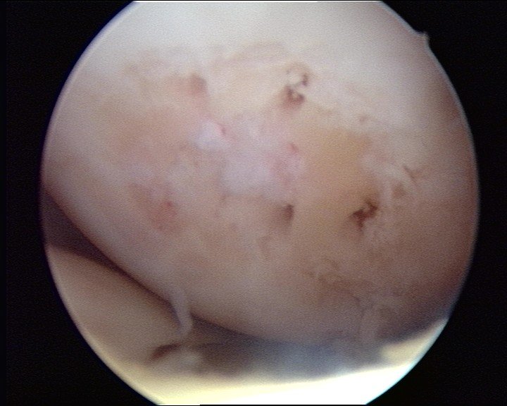 microfracture