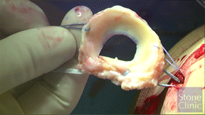 lateral meniscus allograft