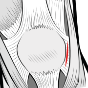 lateral retinacular release