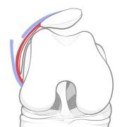 lateral retinacular lengthening