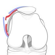 lateral retinacular lengthening