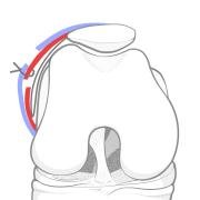 lateral retinacular lengthening
