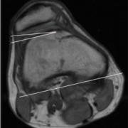 lateral trochlear inclination angle of 11 degrees