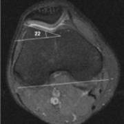 lateral trochlear inclination angle
