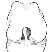 locked bucket handle tear