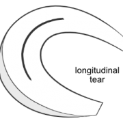 longitudinal meniscal tear