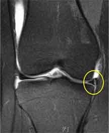 longitudinal tear of meniscus