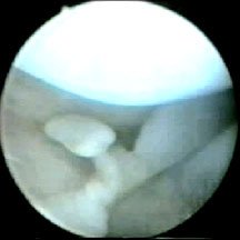 loose body in the knee