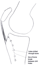 Image showing first stage of maquet osteotomy