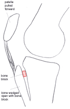Image showing second stage of maquet osteotomy