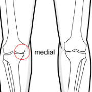 medial joint line thinning of the knee
