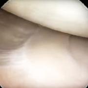 medial meniscus and meniscocapsular junction